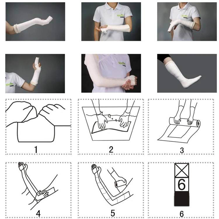 fiberglass splint application4jpg